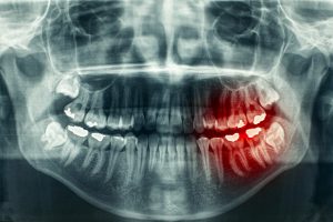 Dental X-Rays Glendale