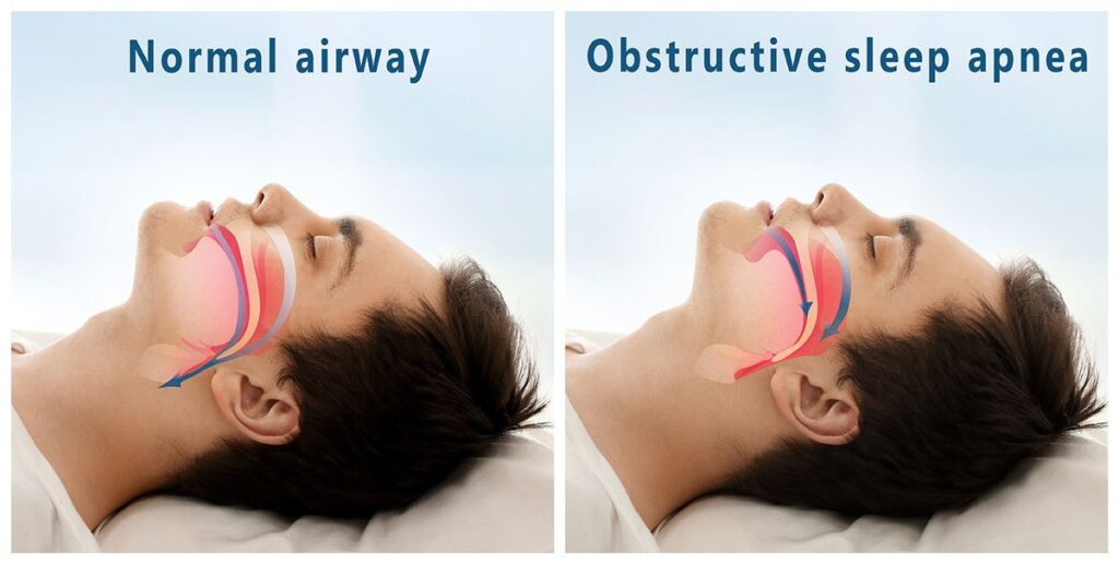 Sleep Apnea is Correlated to Cancer Risk