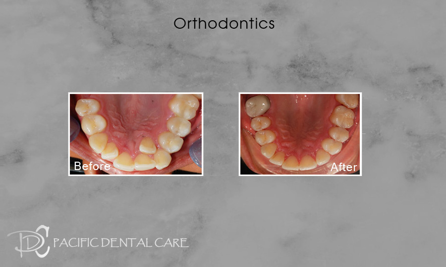 Orthodontics Before After Case 10