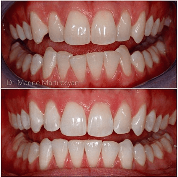 Teeth Whitening Before and After Case 8