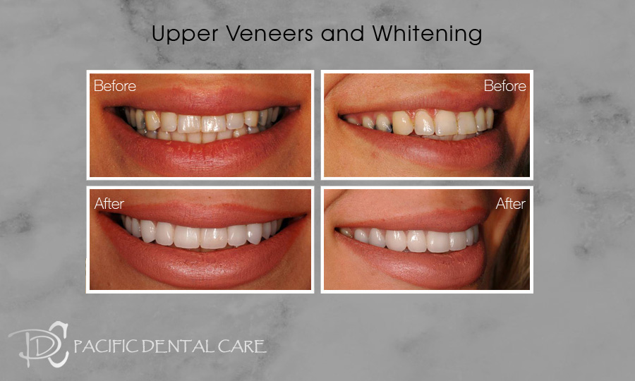 Upper Veneers and Whitening Before and After