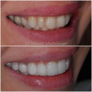 Veneer Before and After 1