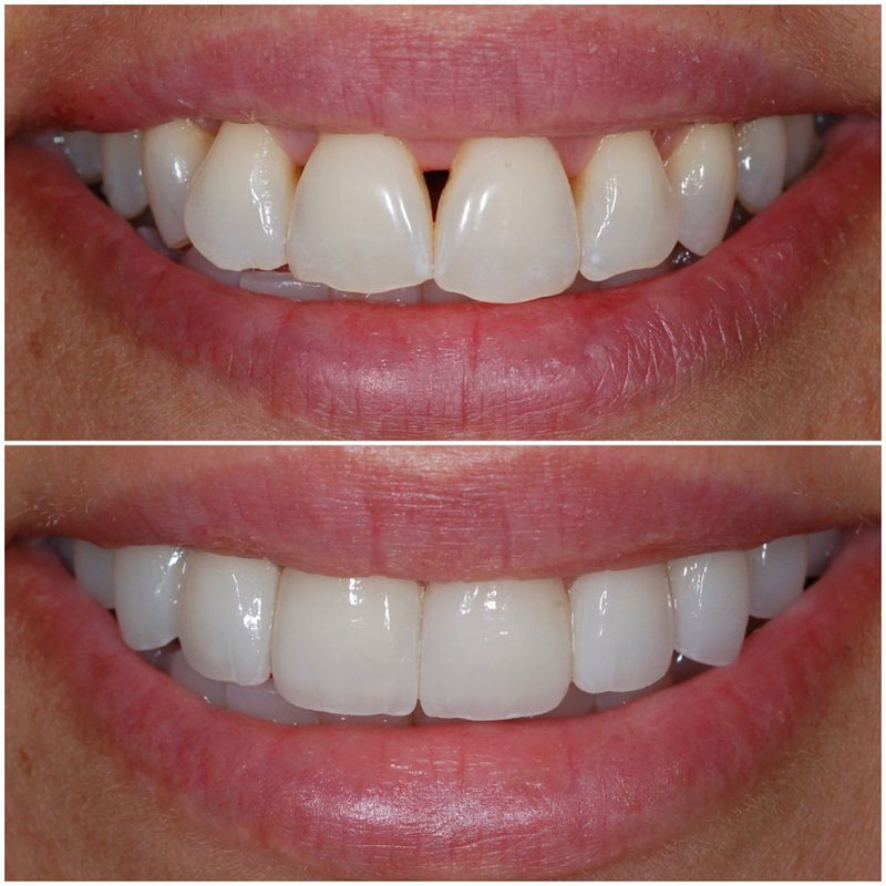 NoPrep Veneers Glendale Burbank Pacific Dental Care