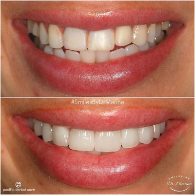 Veneers Before and After Front 43