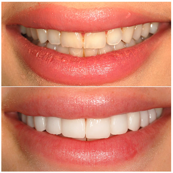 Veneers Before and After Front 44