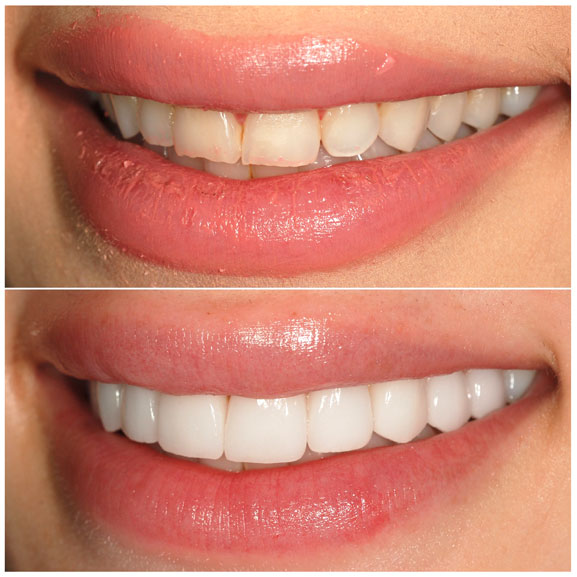 Veneers-Before-and-After-Left-44