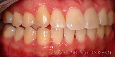 Orthodontics Before and after
