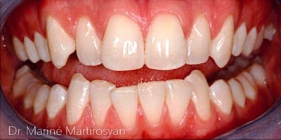 Orthodontics Before and after