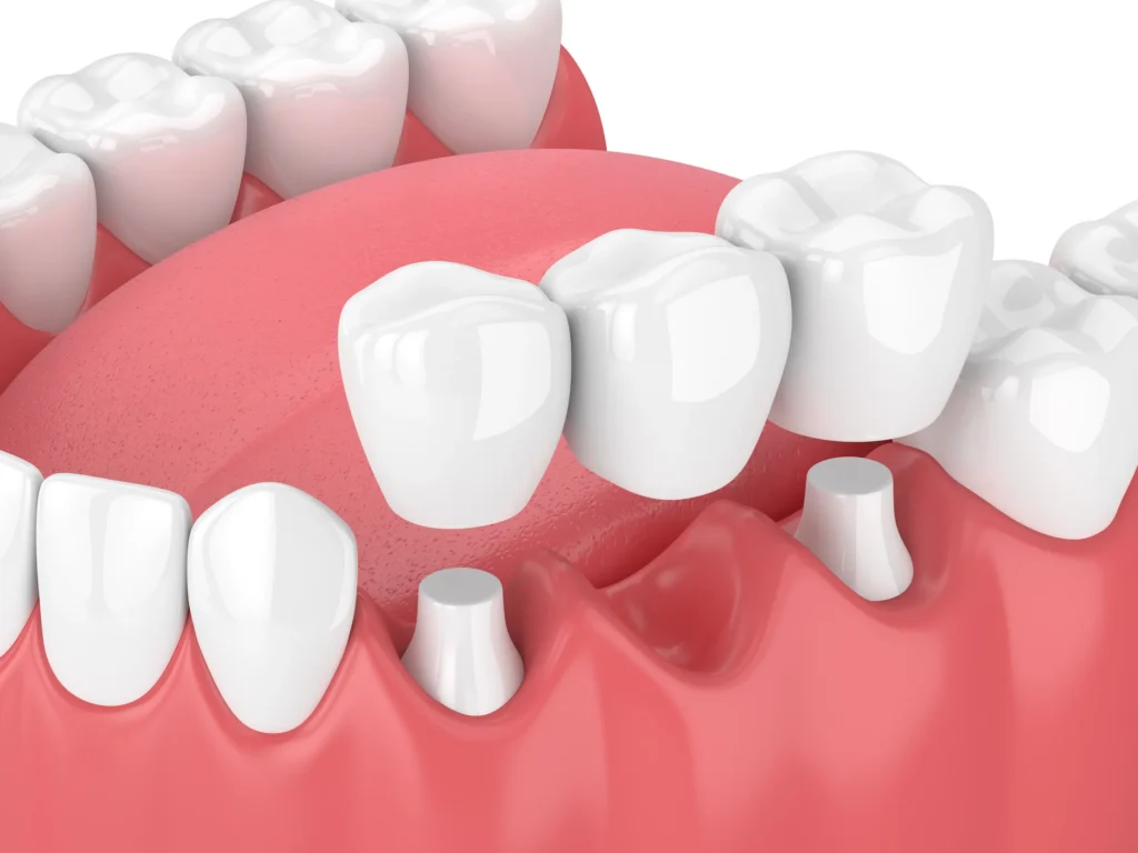 Illustration of a dental implant beside natural teeth