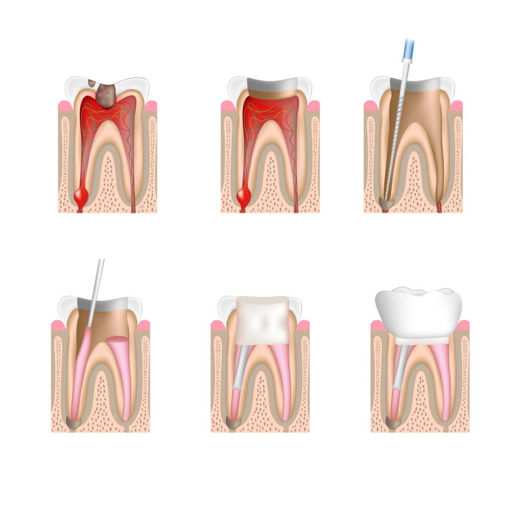 Illustration of the stages of a root canal