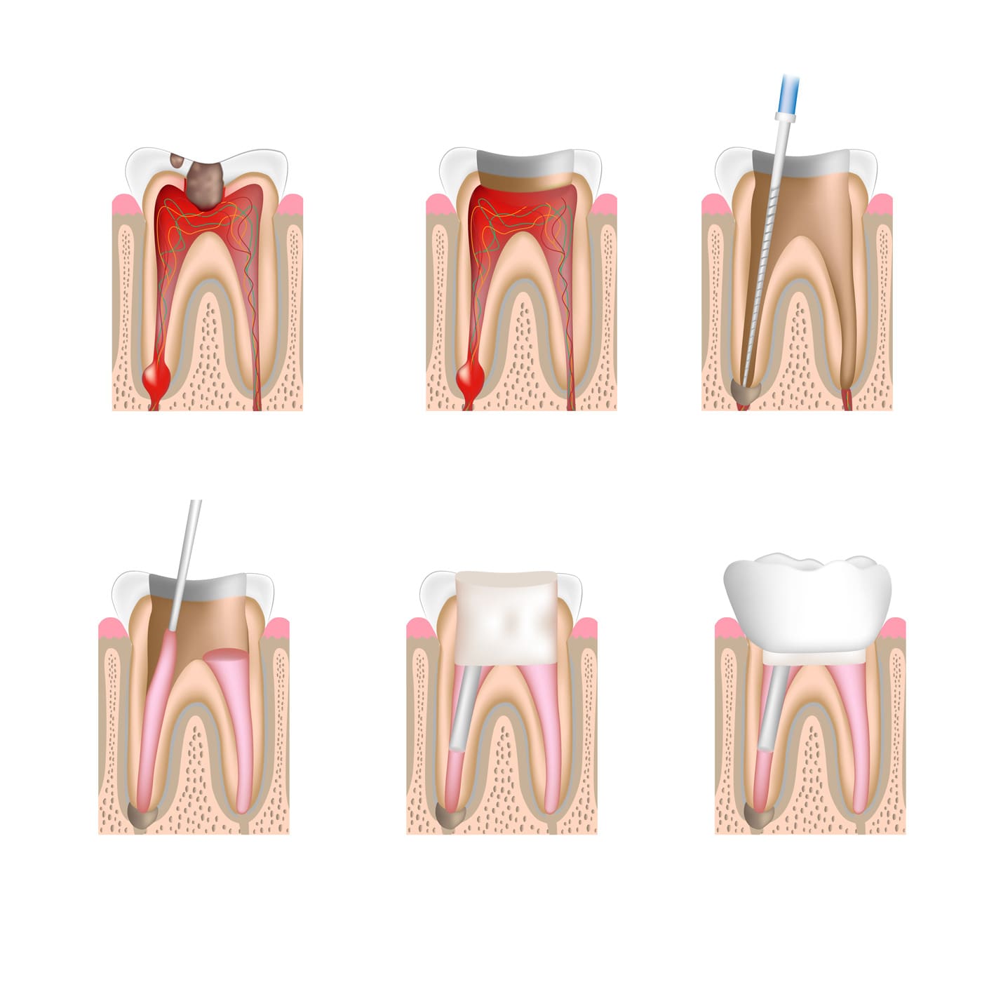 Illustration of the stages of a root canal