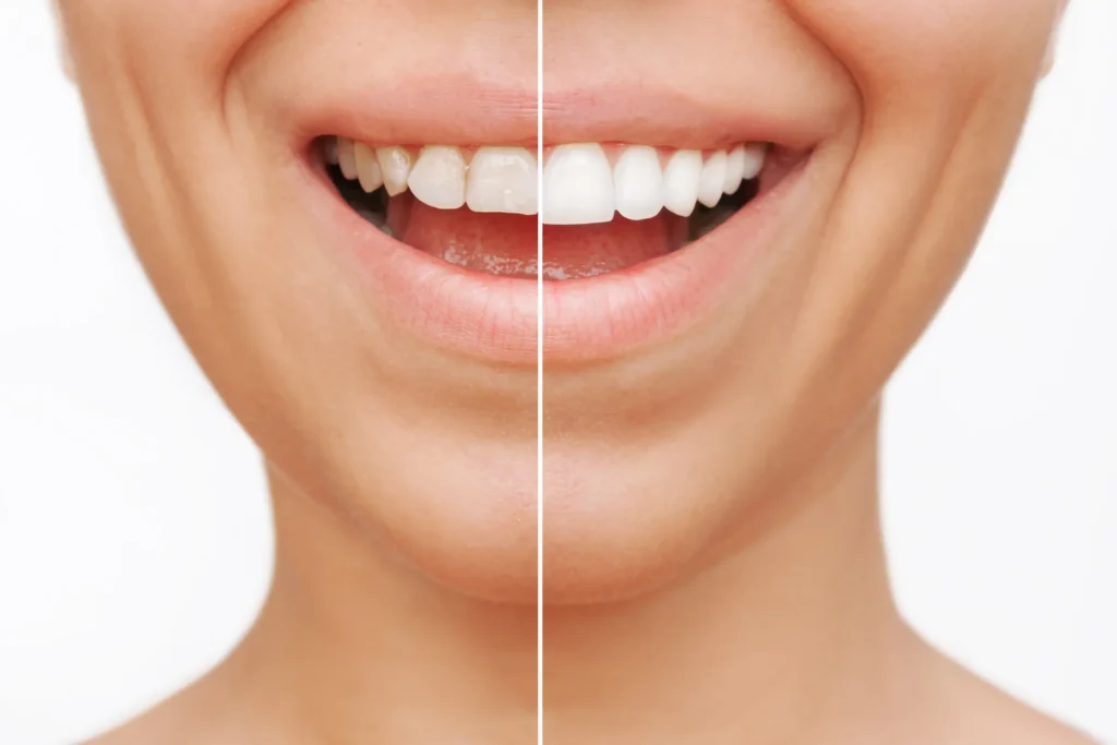 Split view of a smile before and after teeth whitening