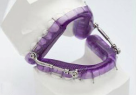Snap Fit Telescopic Herbst oral appliance