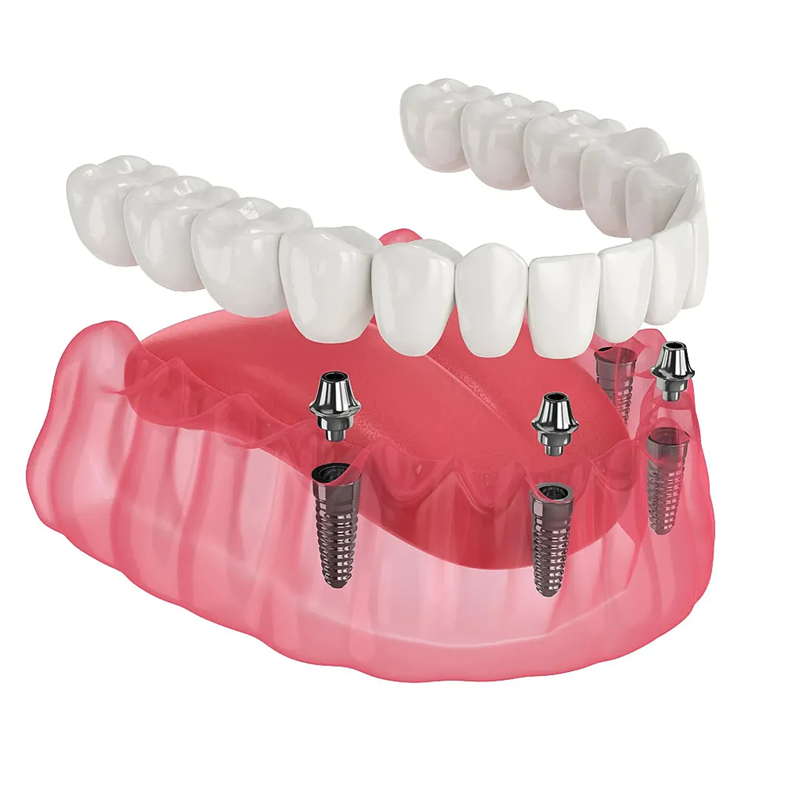 Illustration of a full-arch restoration supported by four implants