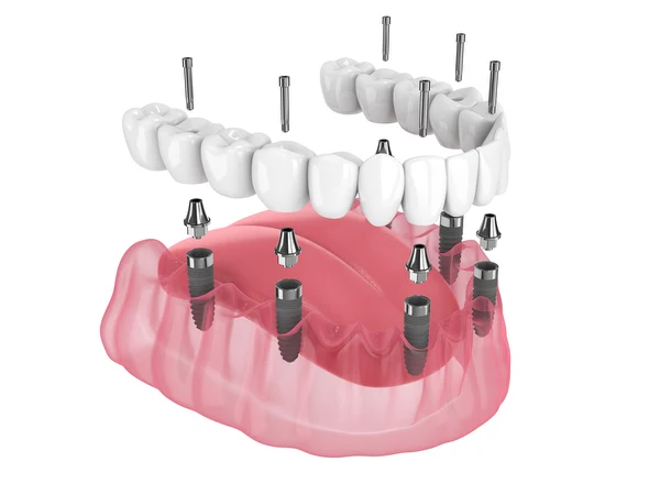 Illustration of an All-on-6 implant restoration