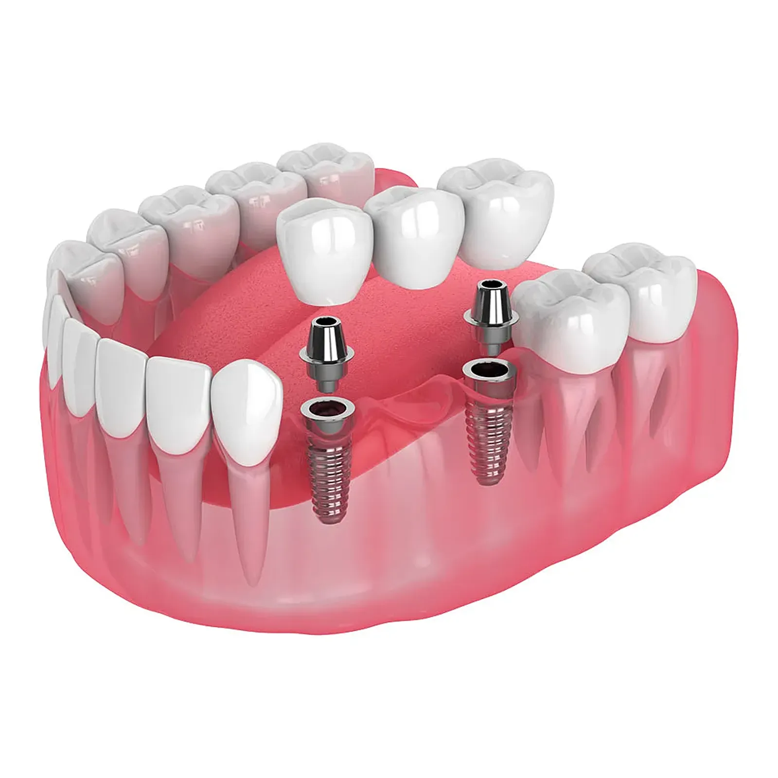 Illustration of a dental bridge supported by two implants