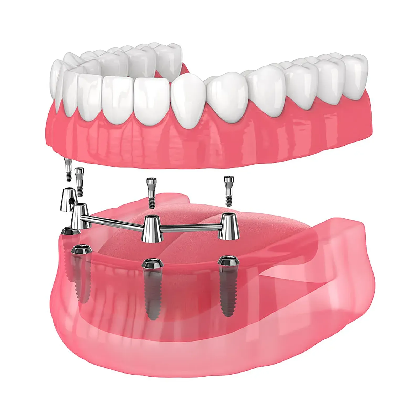 Illustration of a denture secured to implants with a connecting bar