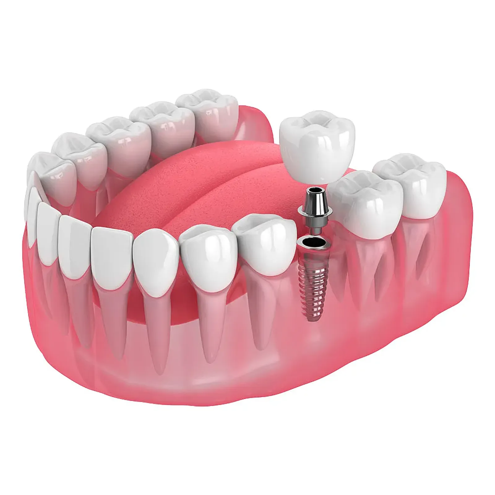 Illustration of a single implant with abutment and crown
