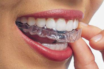 A clear Invisalign aligner being placed